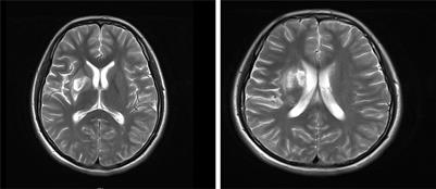 Case Report: Atrial myxoma combined with hyperthyroidism in an adolescent with literature review